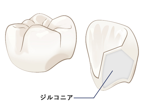 ジルコニアセラミック