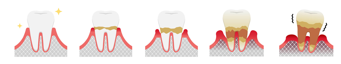歯周病の進行